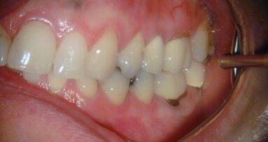 Een 37-jarige follow-up van een endodontisch behandeld element met een perforatie