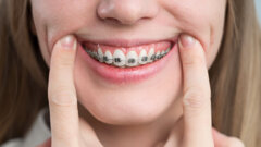 Synergie péri-ortho : « Une excellente santé parodontale est indispensable pour un résultat orthodontique escompté ».