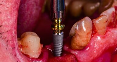 Silver nanoparticle-coated membrane may enhance dental implant treatment