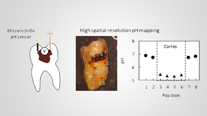 日研究人员发现对抗龋齿的新武器——微型pH传感器