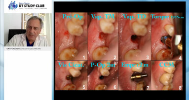 Webinaire en libre accès : applications du Waterlase en implantologie et chirurgie orale