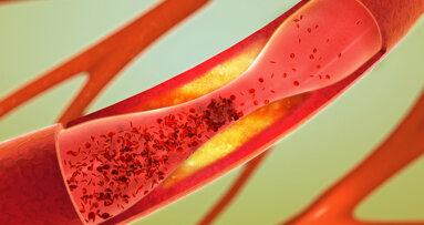 Bakterien im Mund: Auslöser für Arteriosklerose?