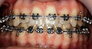 Aesthetics and function: Orthodontic–surgical collaboration as a key to success