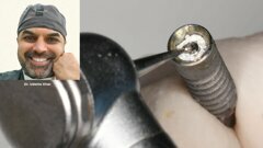 Broken screw removal hack - Dr. Udatta Kher