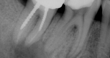Imagerie 3D et endodontie : la supposition devient décision scientifique