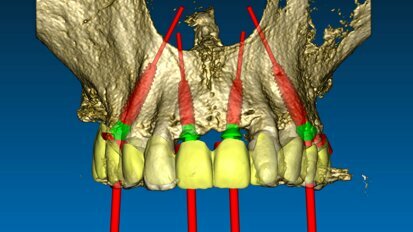 Il flusso digitale nelle riabilitazioni implanto-protesiche in chirurgia guidata