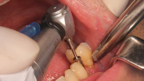 Zerwanie śruby mocującej przenośnik wszczepu stomatologicznego jako powikłanie śródzabiegowe