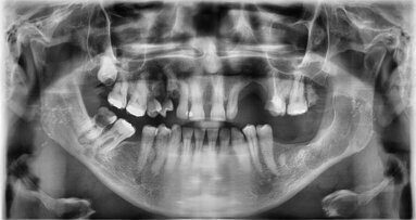 Zastosowanie masy bogatopłytkowej we wspomaganiu leczenia chirurgicznego torbieli zębopochodnych kości szczękowych