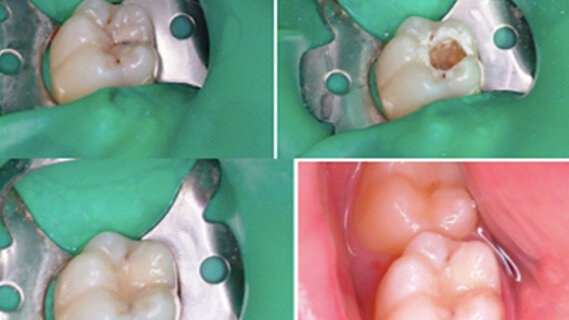 Avantages de l’utilisation du laser Er:YAG chez les patients ayant des besoins spéciaux. Dentisterie conservatrice: étude clinique
