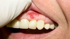 Glede na novo študijo togost dlesni vpliva na dovzetnost za vnetja