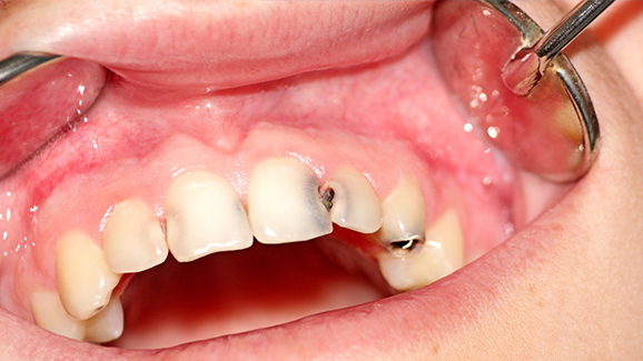 Grundlegende Empfehlungen zur Kariesprophylaxe bei bleibenden Zähnen
