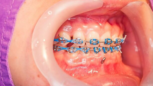 Tandartsen doen zich onterecht voor als orthodontist
