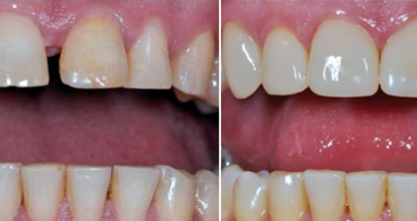 Фабрични фасети за фронтални зъби