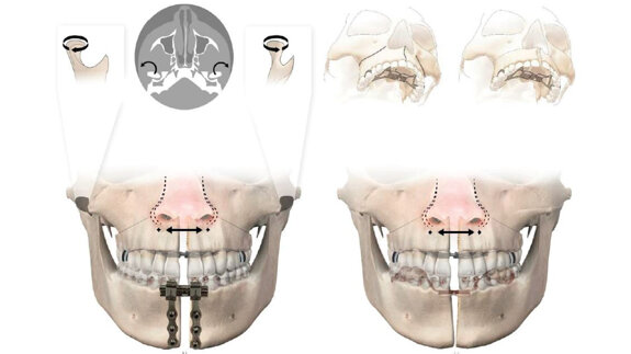 Kaakverbreding voorkomt extracties bij orthodontie