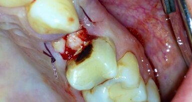 Zastosowanie fibryny bogatopłytkowej (PRF) w stomatologii