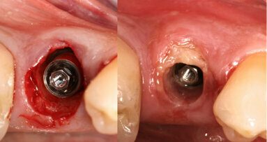 Immediate loading of a socket shield post-extraction implant with the final CAD/CAM crown