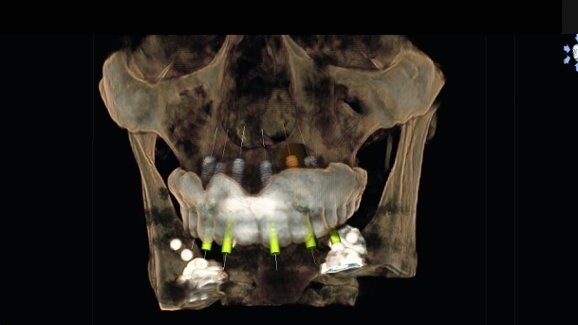 The 3-D Difference: Cone Beam CT diagnostics to enhance treatment—Part II
