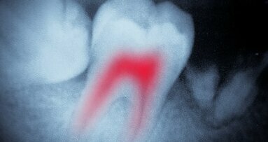 Lane keeping assistance systems in endodontics