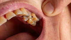 新指南提供了关于龋齿治疗和牙髓治疗的更新内容