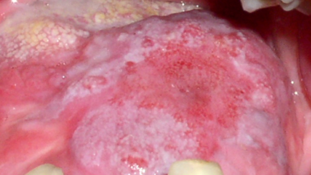 Sustancias coadyuvantes en el manejo de la mucositis oral