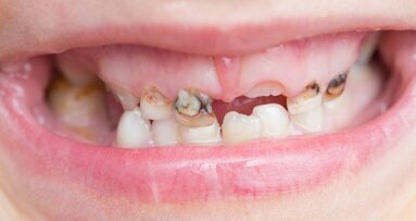 Quase 15 por cento das crianças norte-americanas com menos de 8 anos têm cárie dentária não tratada