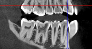 3D technologie v diagnostice a léčbě endodontických onemocnění