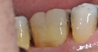 Refuerzo directo complejo de dentina pericervical sometida a tratamiento endodóntico