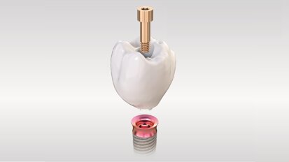 Kooperation von TRI Dental Implants und Amann Girrbach: Implantate ohne Abutment im vollstädig validierten Workflow