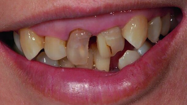 Between BOPT and BTA: A case report on shaping the gingival contour around tooth-supported restorations by means of provisional resin crowns