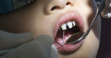 Caries in children: English dentists extract 160 teeth a day