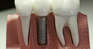 Sneller plaatsen van tandkroon op implantaat mogelijk