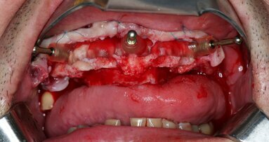 Compromised maxillary dentition treated with Straumann Pro Arch and a digital workflow