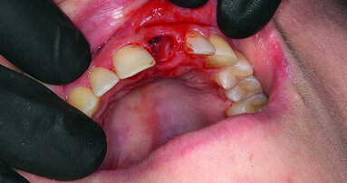 Fast, functional aesthetic solution for anterior tooth trauma