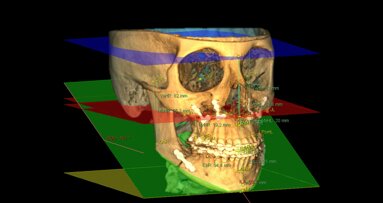 La cefalometria 3D nella pratica ortodontica: continuiamo a parlarne