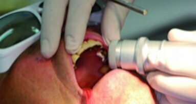 Le laser en dentisterie : passé, présent et futur