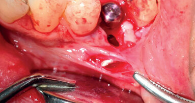 Ruolo del collare in zirconio nella gestione della perimplantite: case report