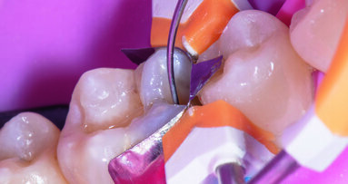 Simplified protocol for adjacent Class II direct resin restorations