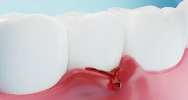 研究使用人工智能来检测牙龈炎