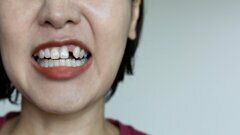 El control deficiente de la glucemia y la pérdida de dientes