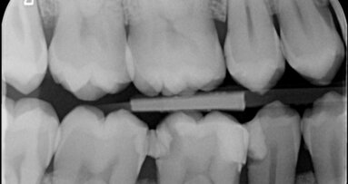Vier jaar later: case report endodontische behandeling 46