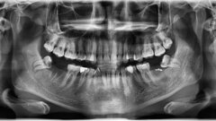 L’analyse de la troisième molaire ne serait pas une technique fiable de l’évaluation de l’âge