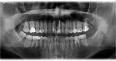 Leczenie endodontyczne autogennego przeszczepu zęba z zastosowaniem lasera Er,Cr:YSGG