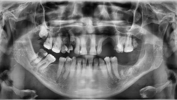 Zastosowanie masy bogatopłytkowej we wspomaganiu leczenia chirurgicznego  torbieli zębopochodnych kości szczękowych