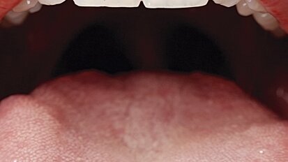 Guía Clínica para la atención odontológica del paciente con cáncer oral (4)