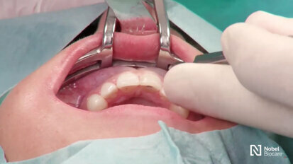 Nobel Biocare - Restoration of a central incisor
