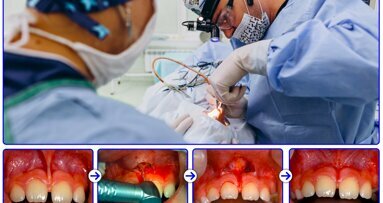 Aplicaciones del láser en Cirugía Bucal (3)