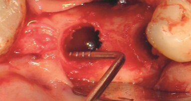 Ubytki w kościach szczęk i ich konsekwencje w implantologii stomatologicznej