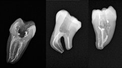 Less-Prep Endo—is a paradigm shift in root canal preparation ahead of us?