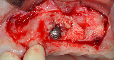 Decontaminazione implantare mediante dispositivo a cavitazione ultrasonica