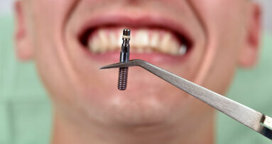 Los errores de los pacientes sobre los implantes dentales